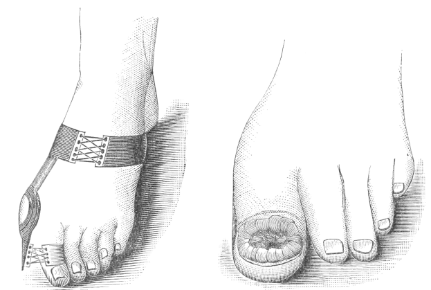 Schwarze und weiße Zeichnung von einem Paar Füße, eines mit einem bandagierten Bruch und das andere mit einer sichtbaren Fraktur, begleitet von Text unten.