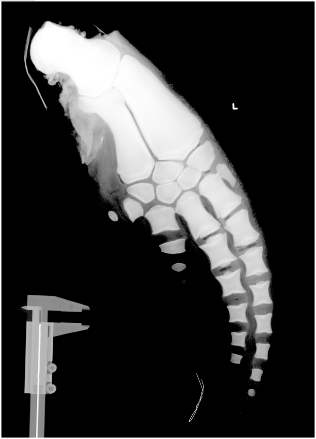 Ein Röntgenbild eines Mannes mit einer Fraktur in der Mitte, mit einem Metallband auf der linken Seite, vor schwarzem Hintergrund.
